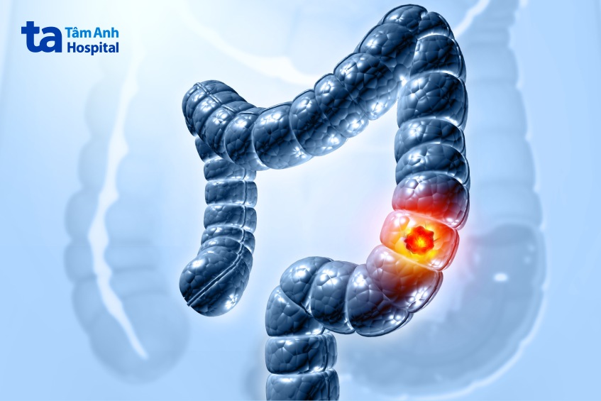 ung thư đại tràng thường xuất phát từ polyp