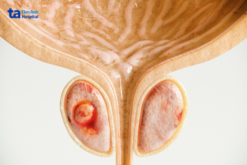 ung thư tiền liệt tuyến có nguy hiểm không