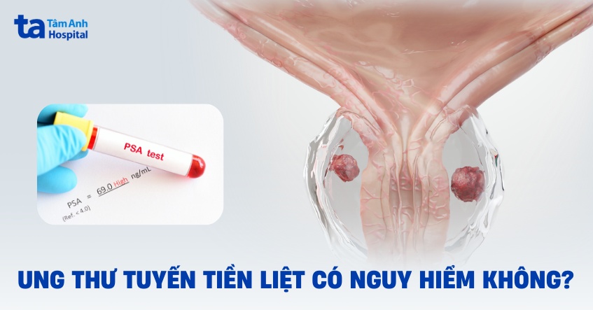 Ung thư tuyến tiền liệt có nguy hiểm không? Ảnh hưởng ra sao?