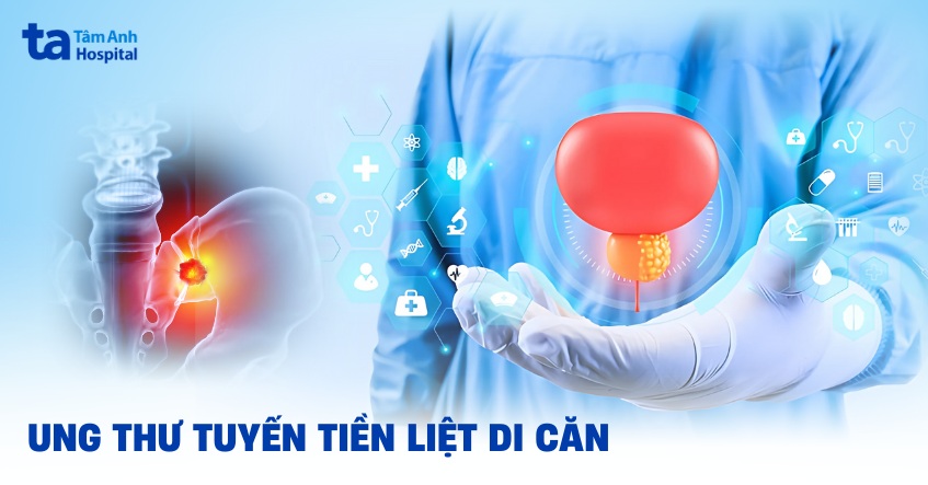 Ung thư tuyến tiền liệt di căn: Dấu hiệu, chẩn đoán và điều trị