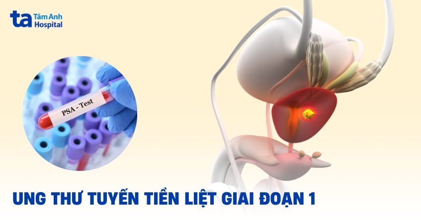 Ung thư tuyến tiền liệt giai đoạn 1: Dấu hiệu, chẩn đoán, điều trị