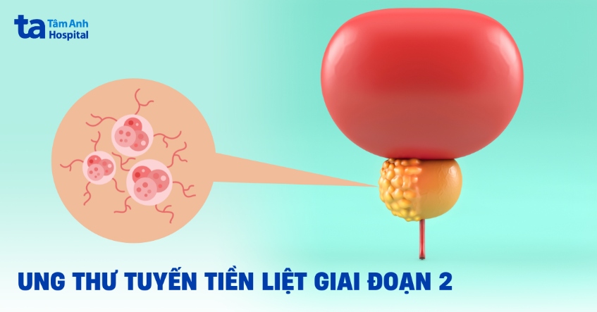 Ung thư tuyến tiền liệt giai đoạn 2: Dấu hiệu, chẩn đoán, điều trị