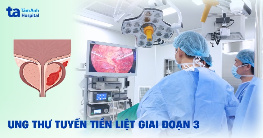 Ung thư tuyến tiền liệt giai đoạn 3: Triệu chứng và cách điều trị