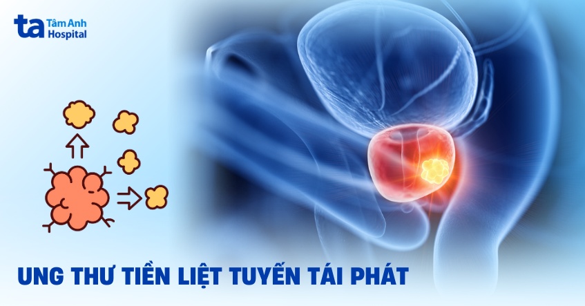 Ung thư tuyến tiền liệt tái phát: Dấu hiệu, chẩn đoán và điều trị