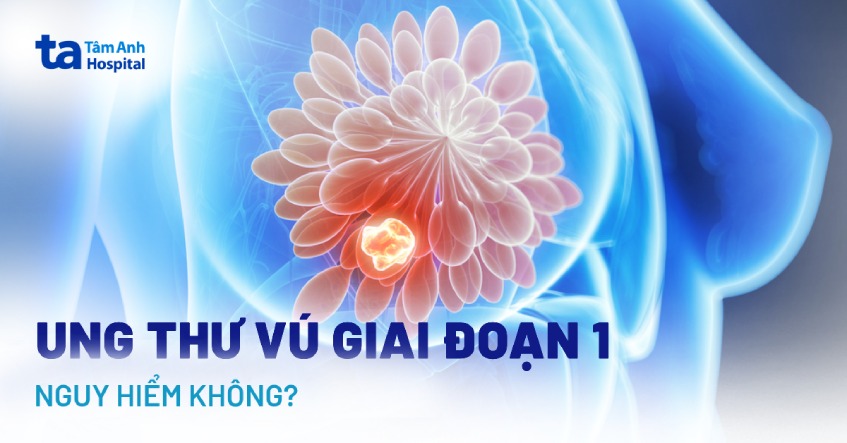 Ung thư vú giai đoạn 1 có nguy hiểm không? Có di căn không?