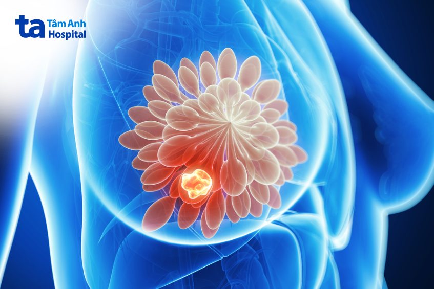 ung thư vú giai đoạn 1 có thể xuất hiện tế bào ung thư ở tiểu thùy