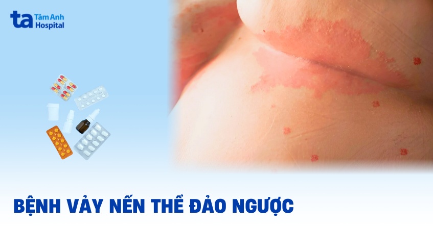 vảy nến đảo ngược