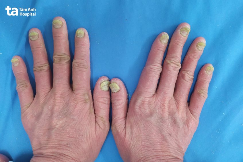 vảy nến không trực tiếp gây ra sẹo