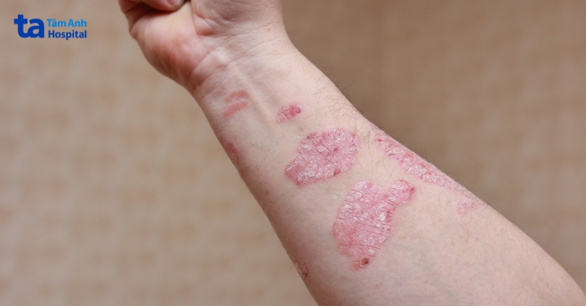 vảy nến thể mảng xuất hiện ở đâu