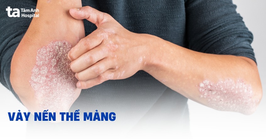 vảy nến thể mảng