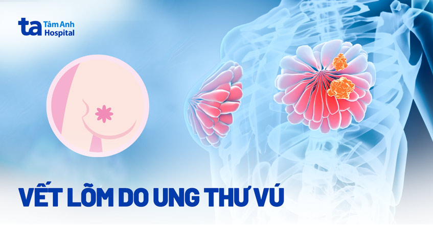 Vết lõm do ung thư vú: Nguyên nhân, ý nghĩa và cách nhận biết
