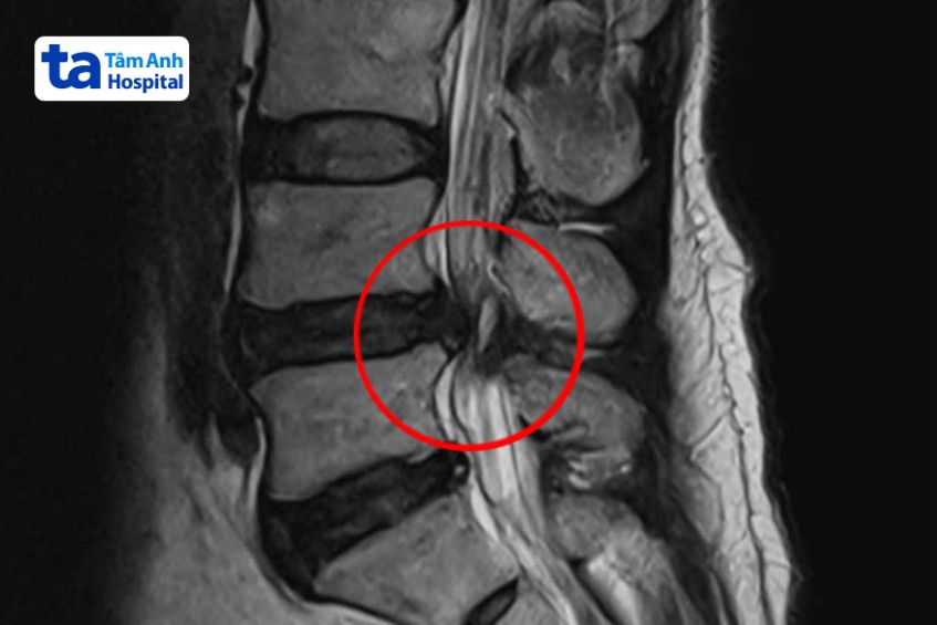 vị trí đốt sống tổn thương
