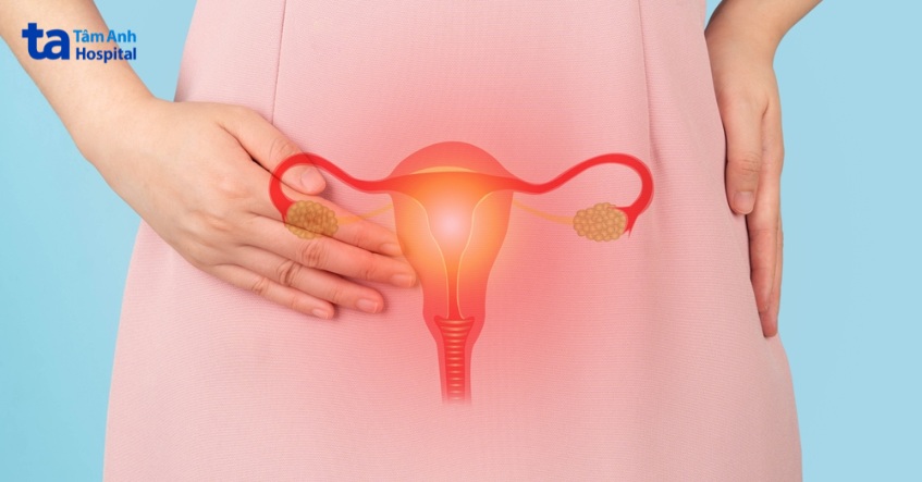 viêm âm đạo cũng có thể là nguyên nhân