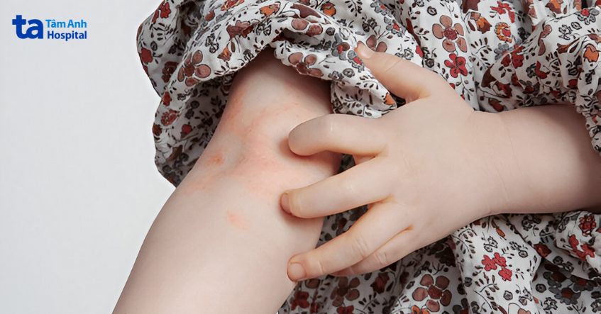 viêm da cơ địa thường bùng phát mạnh mẽ vào mùa đông