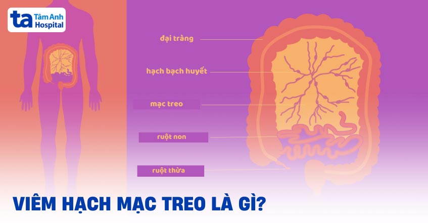 viêm hạch mạc treo