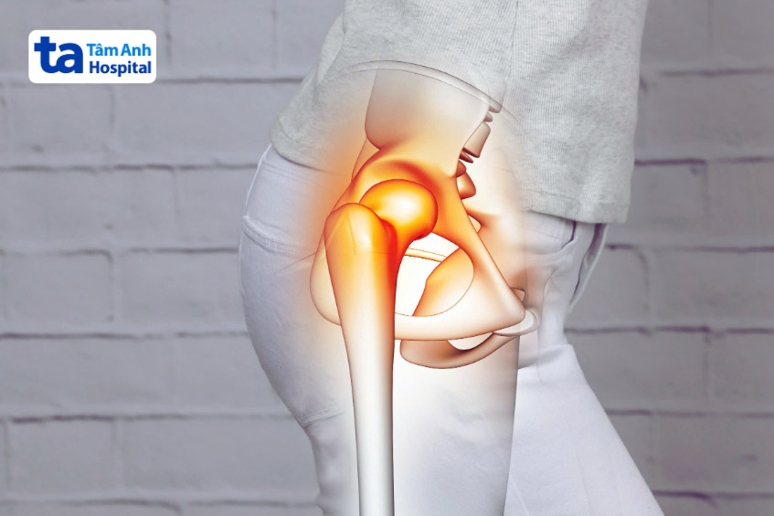 Viêm khớp háng do chấn thương thể thao