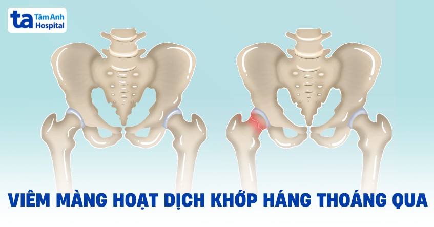 viêm màng hoạt dịch khớp háng thoáng qua