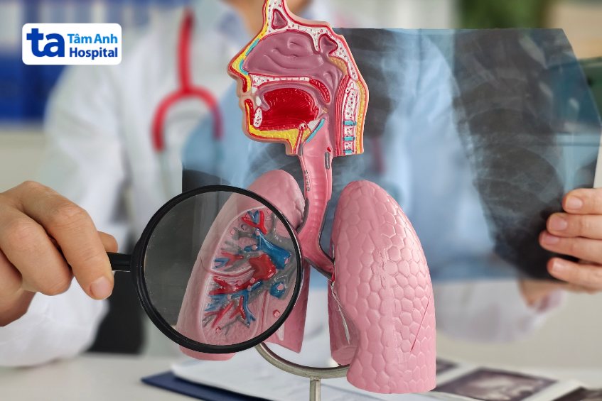 viêm phế quản co thắt là biến chứng nặng của bệnh viêm phế quản