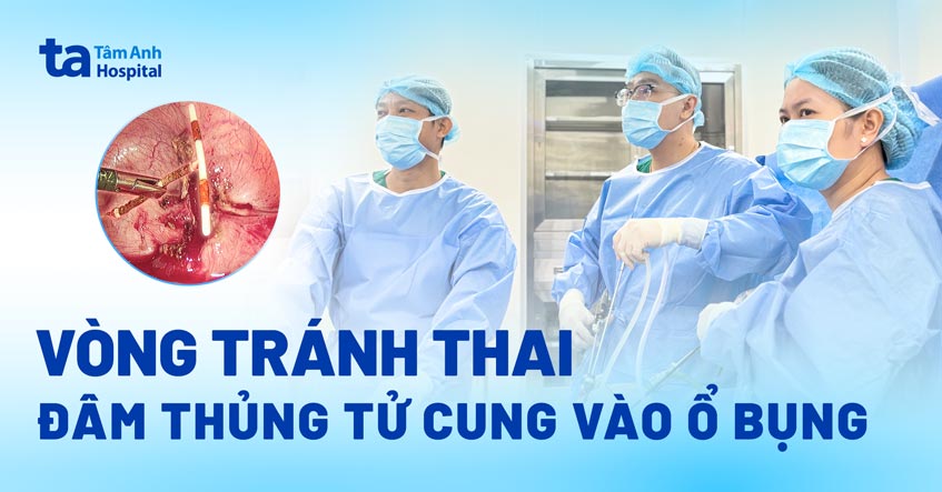vòng tránh thai đâm thủng tử cung