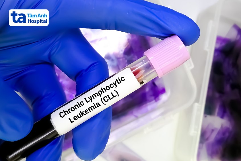 xét nghiệm chẩn đoán bạch cầu lympho