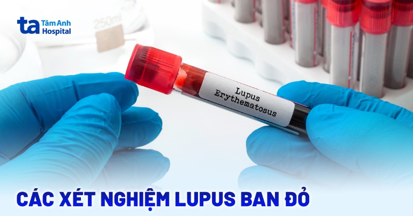 Các xét nghiệm lupus ban đỏ giúp xác định tình trạng bệnh