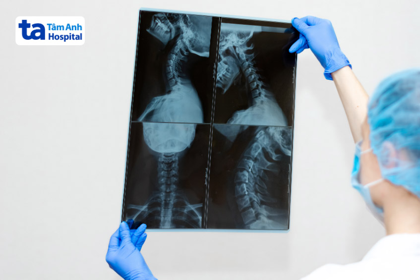 Xquang chẩn đoán đau cổ vai gáy lan xuống cánh tay