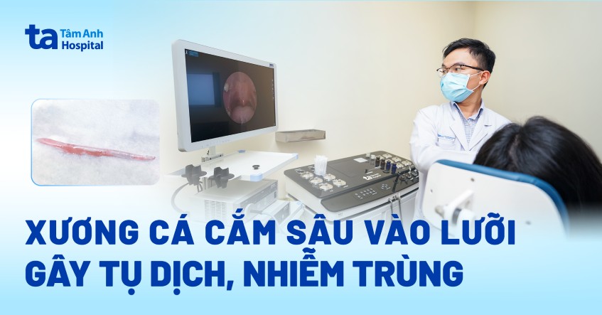 xương cá cấm sâu vào lưỡi