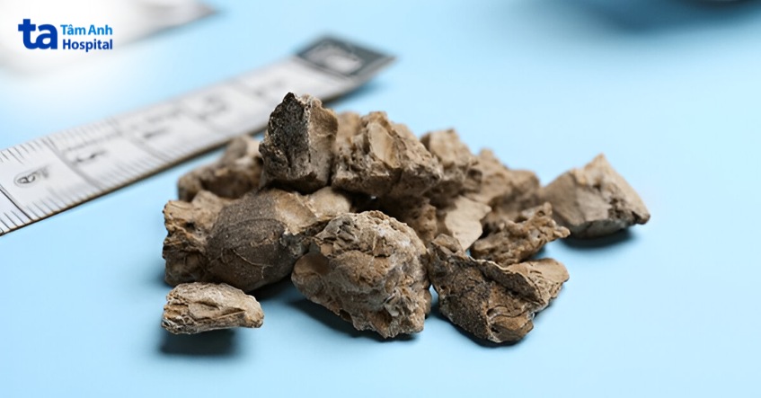 yếu tố nào ảnh hưởng đến quá trình điều trị sỏi niệu quản