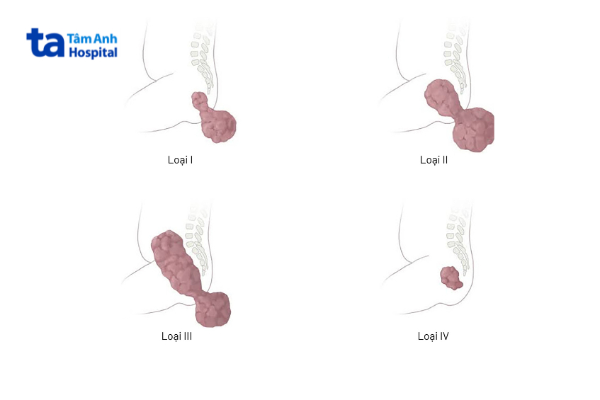 4 loại u quái vùng cùng cụt