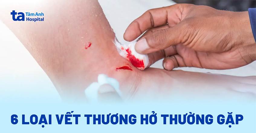 Vết thương hở là gì? 6 loại vết thương hở thường gặp