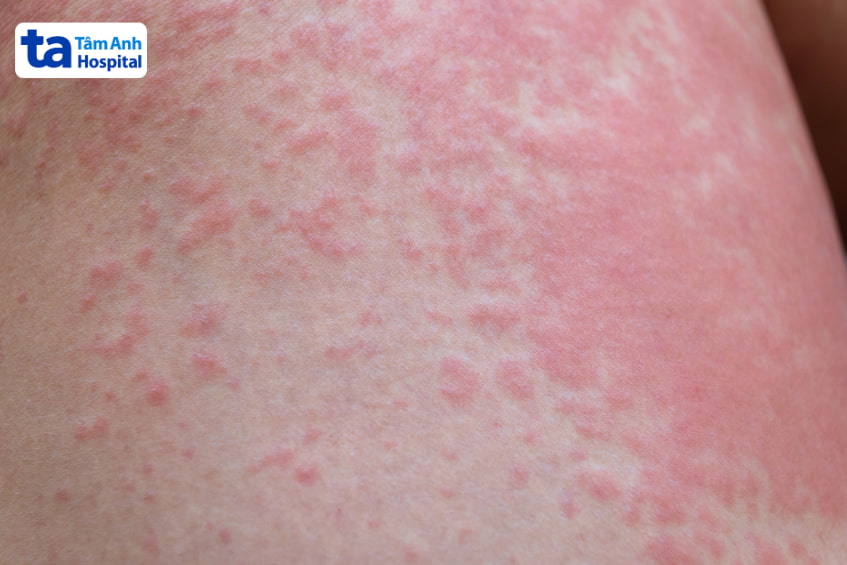 Quá liều và quên liều thuốc Ampicillin