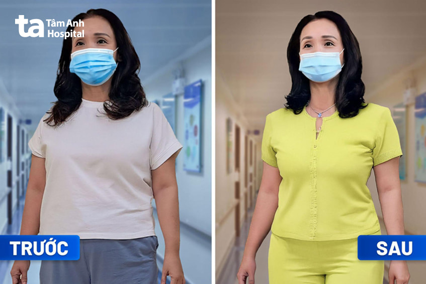 Chị M.N.L. trước và sau giảm cân tại BVĐK Tâm Anh