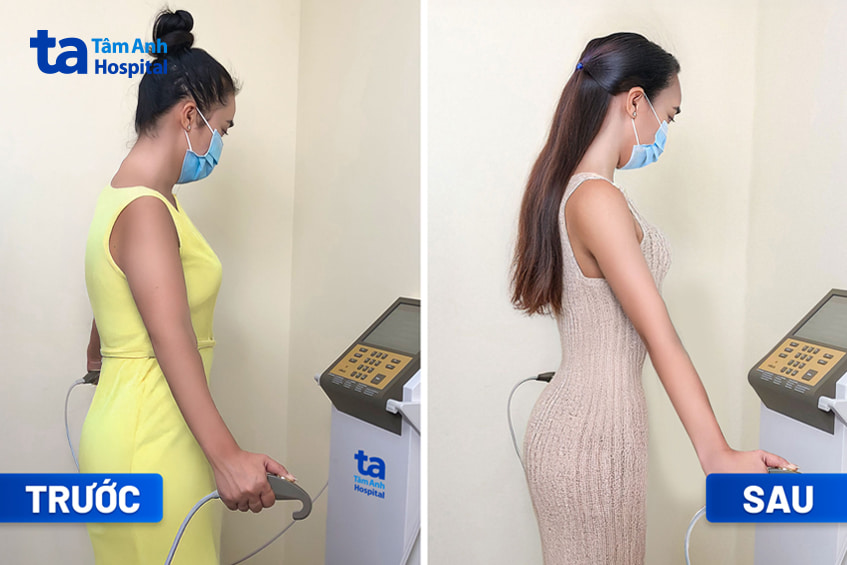 Chị Lê Thị Mỹ Ngọc trước và sau giảm cân