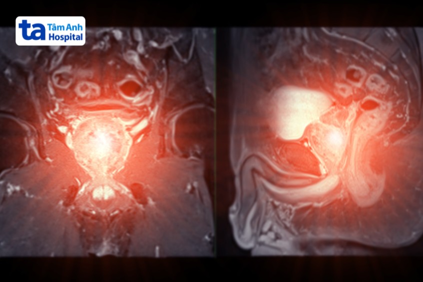 ảnh chụp mri chẩn đoán ung thư