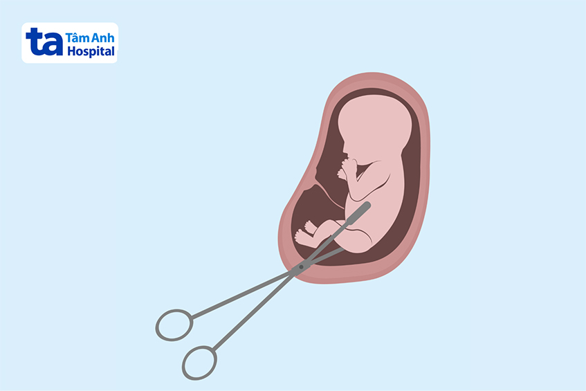 áp dụng với thai 10 tuần tuổi