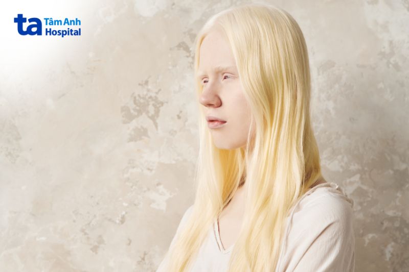 người bệnh bạch tạng thường mắt sẽ hơi mờ