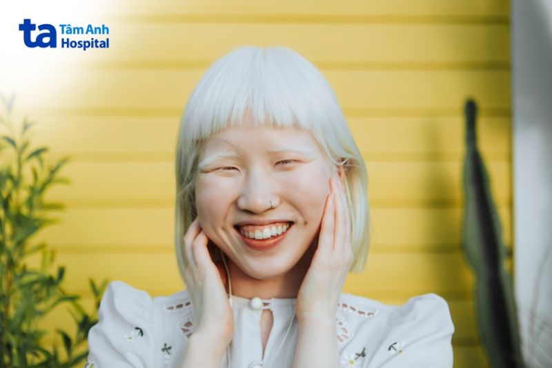 bạch tạng OCA1A có tóc và da rất trắng