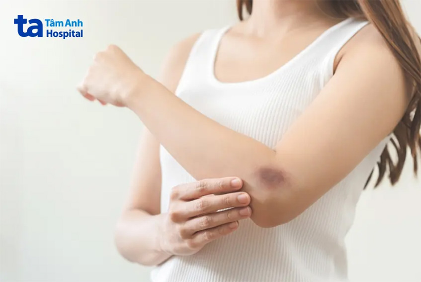 Bầm tím là một dạng của vết thương kín