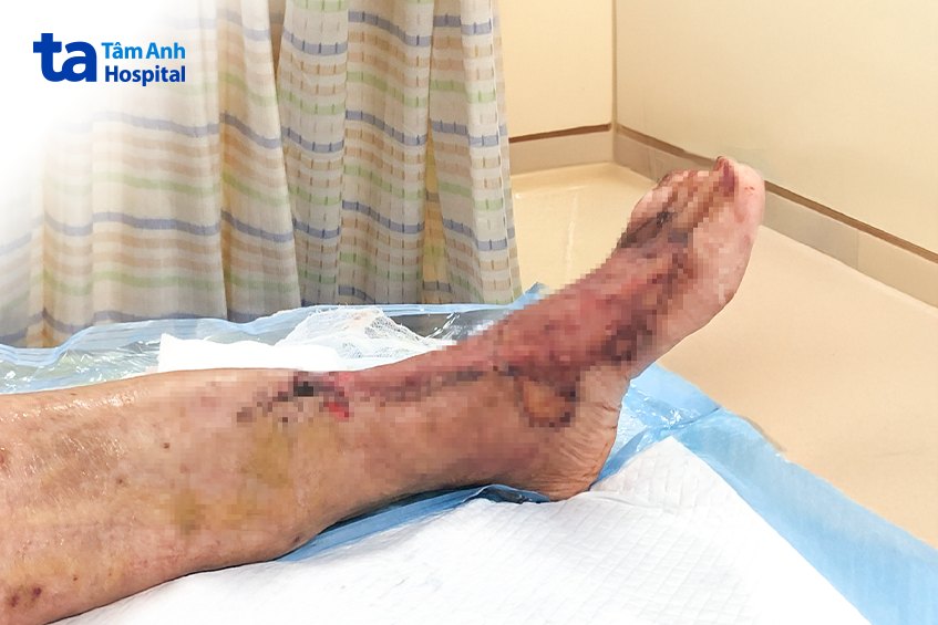 bàn chân của bà d sau khi được ghép da