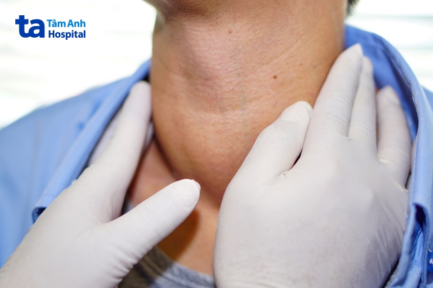 bản chất bướu giáp đơn thuần lành tính