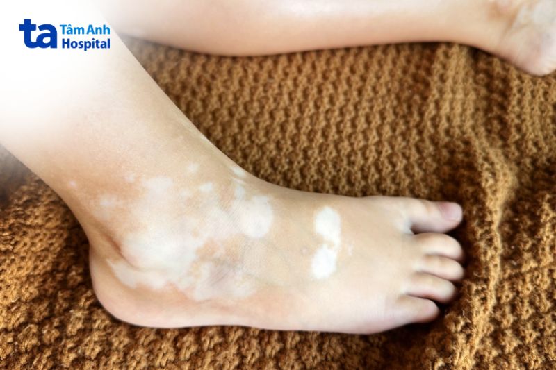 bệnh bạch biến xuất hiện những mảng mất màu