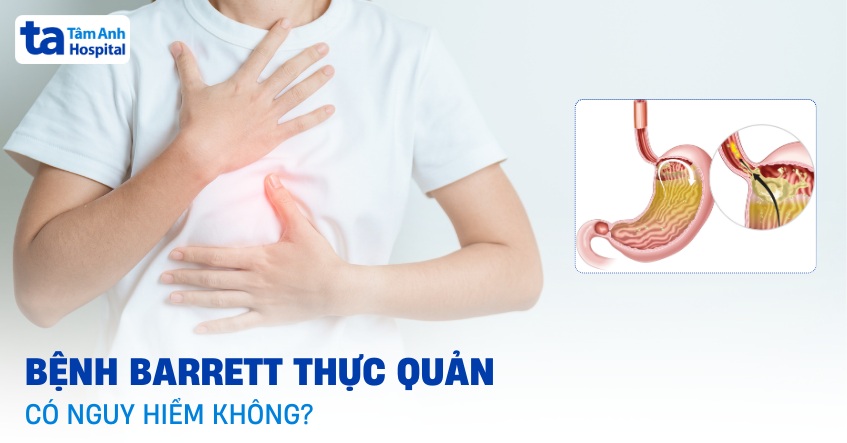 Bệnh Barrett thực quản có nguy hiểm không? Biến chứng thường gặp