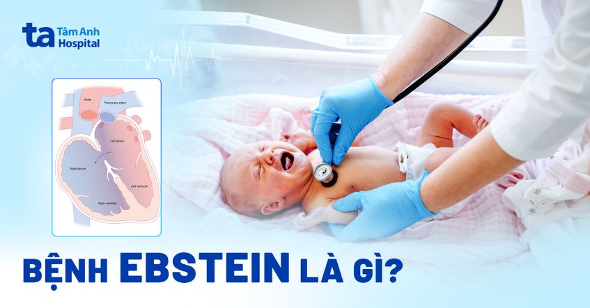 Bệnh tim Ebstein là gì? Nguyên nhân, dấu hiệu, chỉ định can thiệp