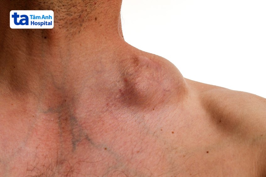 bệnh gây sưng hạch suy giảm miễn dịch