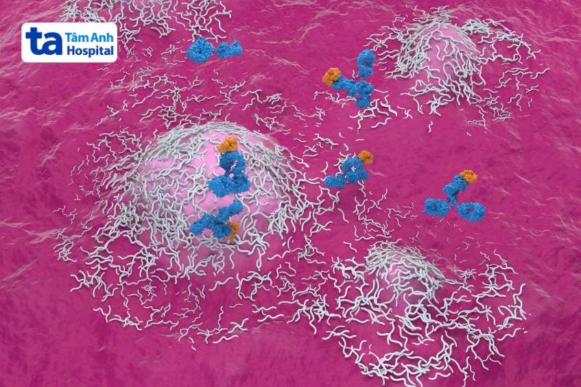 bệnh u màng não thất là gì