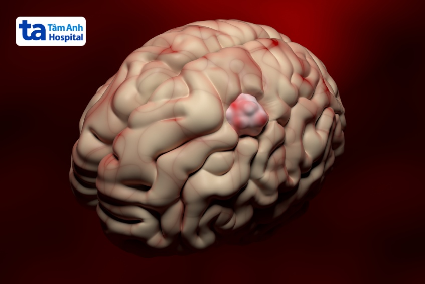bệnh u não lành tính có nguy cơ tái phát