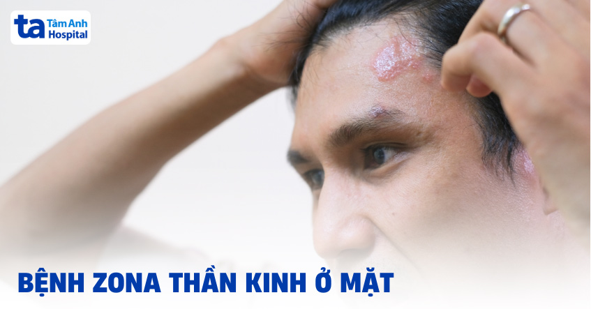 Bệnh zona thần kinh ở mặt: Nguyên nhân, biểu hiện và cách trị