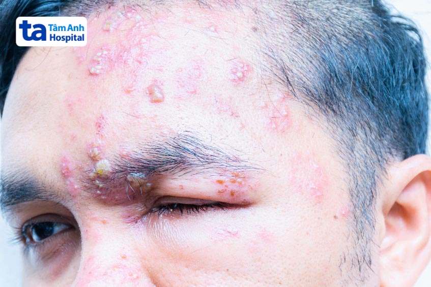 bệnh zona thần kinh ở mắt