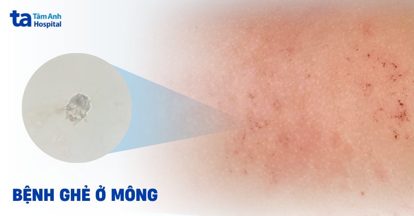 Ghẻ ở mông: Hình ảnh, nguyên nhân, dấu hiệu và cách phòng ngừa