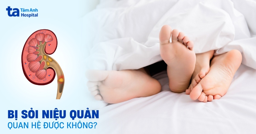 Bị sỏi niệu quản có quan hệ được không? Cần lưu ý điều gì?